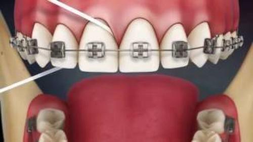 Как использовать зубную нить. Пошаговая инструкция по использованию зубной нити