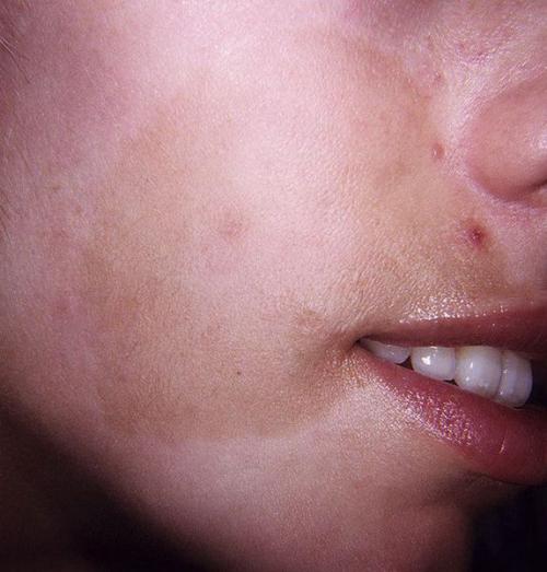 Как убрать возрастные пигментные пятна. Симптомы гиперпигментации кожи 06