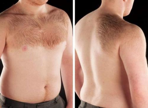 Как убрать возрастные пигментные пятна. Симптомы гиперпигментации кожи 02