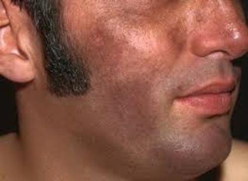 Как убрать возрастные пигментные пятна. Симптомы гиперпигментации кожи 07