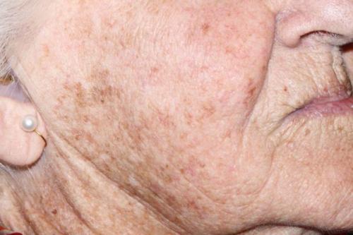 Как убрать возрастные пигментные пятна. Симптомы гиперпигментации кожи 05