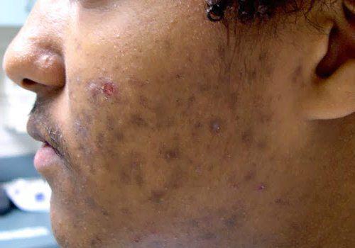 Как убрать возрастные пигментные пятна. Симптомы гиперпигментации кожи 03