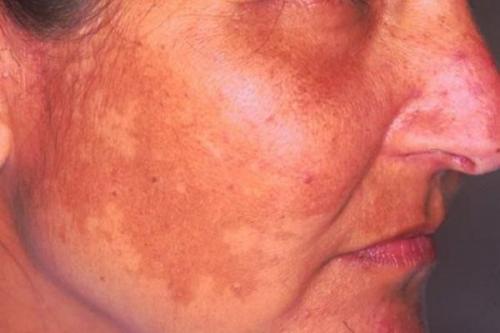 Как убрать возрастные пигментные пятна. Симптомы гиперпигментации кожи 01