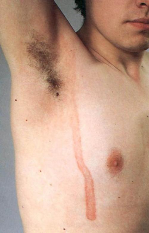 Как убрать возрастные пигментные пятна. Симптомы гиперпигментации кожи 04