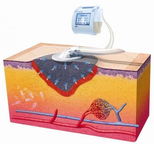 Какие методы лечения долго незаживающих ран наиболее эффективны